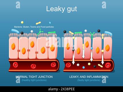 Leaky gut. Close-up of cells of a intestinal epithelium. Difference between Healthy cells, and inflamed intestinal cells. Comparison normal tissue of Stock Vector