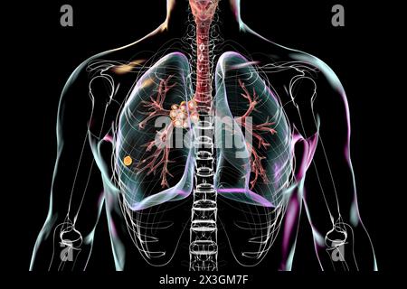 Illustration of primary lung tuberculosis with the Ranke complex, highlighting pulmonary lesions and mediastinal lymphadenitis. Stock Photo