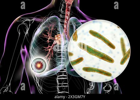 Illustration of primary lung tuberculosis with the Ranke complex ...