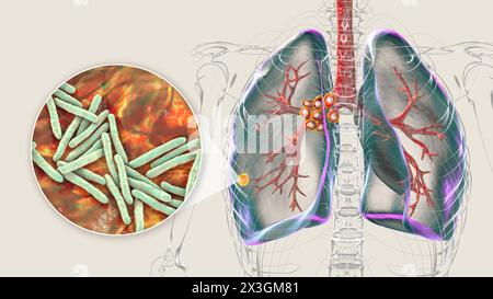 Illustration of primary lung tuberculosis with the Ranke complex, highlighting pulmonary lesions and mediastinal lymphadenitis with close-up view of Mycobacterium tuberculosis bacteria. Stock Photo