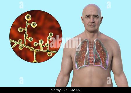 Illustration of a man with lung adiaspiromycosis, a respiratory infection caused by the fungus Emmonsia spp., characterised by the presence of enlarged encapsulated fungal spores within lung tissues. Stock Photo