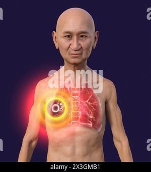 Illustration of a man with lungs affected by cavernous tuberculosis. Stock Photo