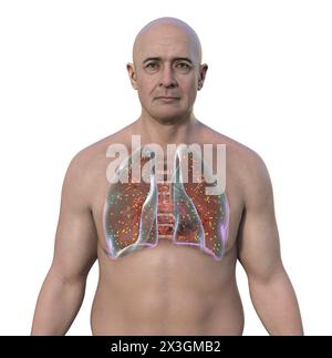 Illustration of a man with lung adiaspiromycosis, a respiratory infection caused by the fungus Emmonsia spp., characterised by the presence of enlarged encapsulated fungal spores within lung tissues. Stock Photo