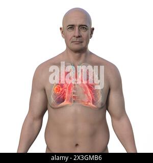 Illustration of a man with a lung mucormycosis lesion. Stock Photo