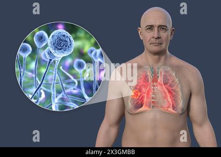 Illustration of a man with a lung mucormycosis lesion and close-up view of Mucor fungi, one of the etiological agents of lung mucormycosis. Stock Photo