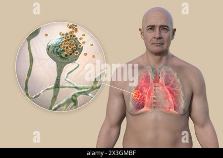 Illustration of a man with a lung mucormycosis lesion and close-up view of Rhizopus fungi, one of the etiological agents of lung mucormycosis. Stock Photo