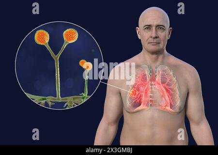 Illustration of a man with a lung mucormycosis lesion and close-up view of Rhizomucor fungi, one of the etiological agents of lung mucormycosis. Stock Photo