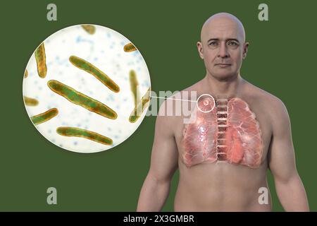 Illustration of a man with lungs affected by secondary tuberculosis and close-up view of Mycobacterium tuberculosis bacteria. Stock Photo