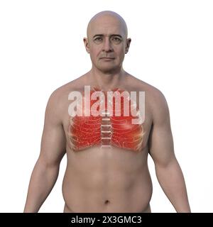 Illustration of a man with lungs affected by miliary tuberculosis. Stock Photo