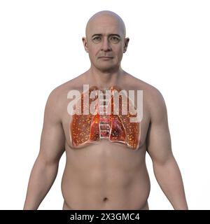 Illustration of a man with lungs affected by miliary tuberculosis. Stock Photo