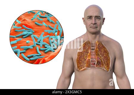 Illustration of a man with lungs affected by miliary tuberculosis and close-up view of Mycobacterium tuberculosis bacteria. Stock Photo