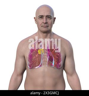 Illustration of a man with primary lung tuberculosis, revealing the Ghon complex and mediastinal lymphadenitis. Stock Photo