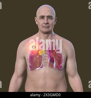 Illustration of a man with primary lung tuberculosis, revealing the Ghon complex and mediastinal lymphadenitis. Stock Photo