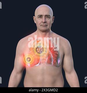 Illustration of a man with primary lung tuberculosis, revealing the Ranke complex and highlighting pulmonary lesions and mediastinal lymphadenitis. Stock Photo