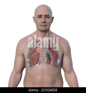 Illustration of a man with primary lung tuberculosis, revealing the Ranke complex and highlighting pulmonary lesions and mediastinal lymphadenitis. Stock Photo