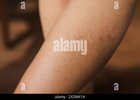 Varicose veins. Vascular diseases. Varicose veins of small vessels on the skin of a woman's thigh. Varicose veins on the woman legs, Vascular, Thrombo Stock Photo