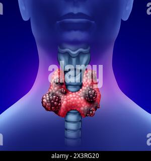 Cancer of the Thyroid gland concept as a human organ with a malignant tumor growth as a symbol for endocrinology system disease. Stock Photo