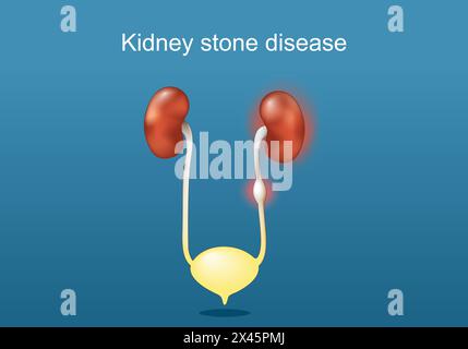 Kidney stone disease. Anatomy human urinary system. Kidneys, ureter with stone, urinary bladder, and urethra. Renal calculi. Vector poster. Isometric Stock Vector