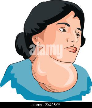 Woman suffering from goitre Stock Vector