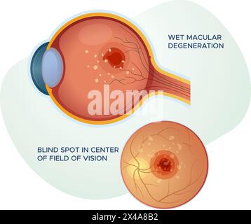 Wet Macular Degeneration - Stock Illustration as EPS 10 File Stock Vector