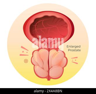 Normal Prostate and Enlarged Prostate Gland under Bladder - Stock Illustration as EPS 10 File Stock Vector