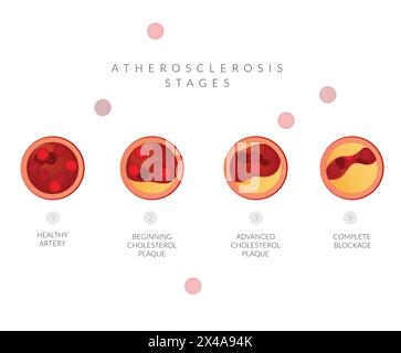 Atherosclerosis Stages - Cholesterol Plaque Buildup - Stock ...