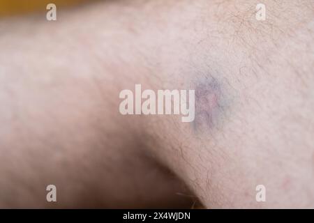 Close-up image of a human knee with a faint bruise and light hair on the skin Stock Photo