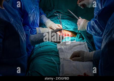 Surgeons performing cesarean section in operating room. Birth surgery with Caesarean. New life, baby being born via Caesarean Section in the operating Stock Photo