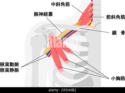Vector illustration of where thoracic outlet syndrome occurs Stock ...