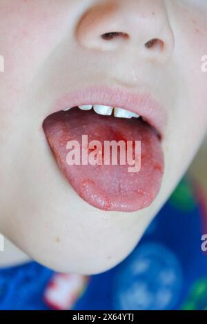 Close-up of lips, tongue, protrusion of blood. Child's bitten tongue. High quality photo Stock Photo