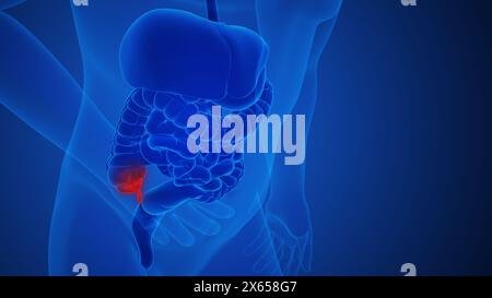 Appendix inflammation pain anatomy for medical concept Stock Photo