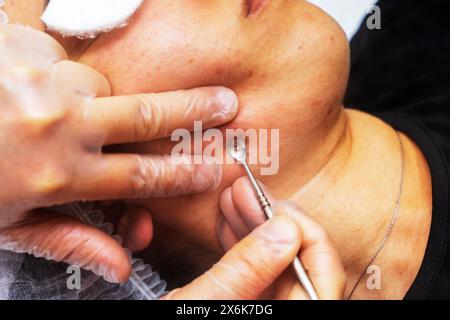 cosmetologist treats the girl's face, a cosmetic procedure Stock Photo