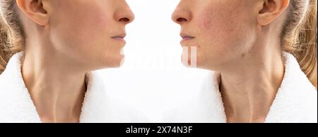 Before and After Skin Acne Treatment. Face of Woman in her 30s with Acne Problem, Couperosis, Scarring, Blackheads. Adult Skin Problem. Cosmetics and Stock Photo