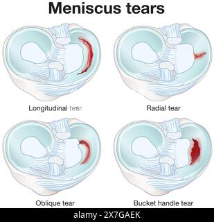 Meniscus tears are knee injuries causing pain, swelling, and limited ...