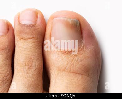 High angle shot of finger with nail fungus infection Stock Photo