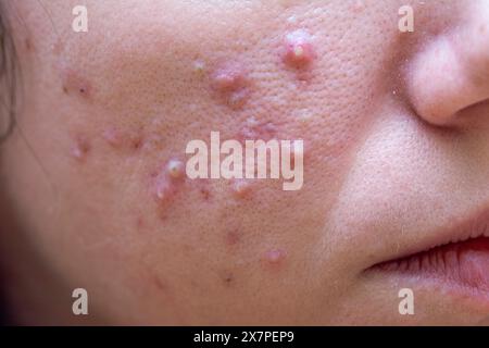 Caucasian female with cystic acne from clogged pores and oily skin ...