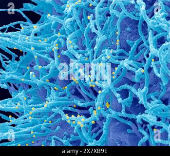 Zika virus. Coloured scanning electron micrograph (SEM) of a U-251 glioblastoma cell line 48hrs after infection with Zika virus. Numerous small viral Stock Photo