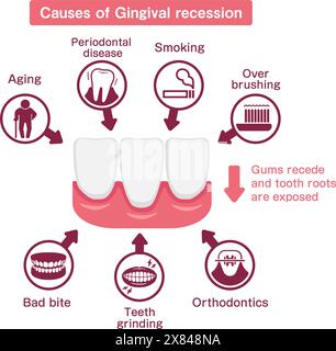 Causes of gingival recession. Vector illustration. Stock Vector