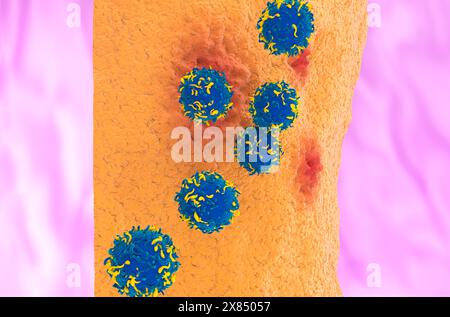 CAR T cell therapy in Rheumatoid arthritis - front view 3d illustration Stock Photo