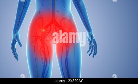 Peripheral nerve clot pain in body Stock Photo