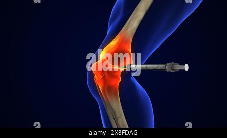 Anatomy Human Knee Joint Treatment, Osteoarthritis Injection Stock Photo