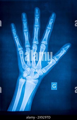 Normal left hand radiograph Stock Photo - Alamy