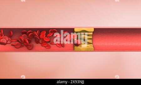 Artery blood clot medical animation Stock Photo