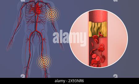 Concept of peripheral pain in human leg and hand Stock Photo