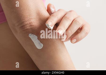 Woman applying elbow cream. Beauty and body care. Winterizing dry itchy skin on the elbow area. Stock Photo