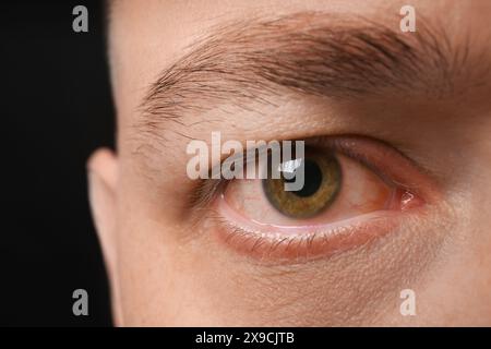 Man with red eye suffering from conjunctivitis on dark background, closeup Stock Photo
