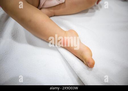 closeup insect bites on baby leg with red allergy spot Stock Photo