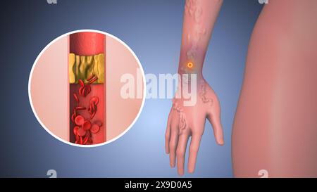 Peripheral pain in human hand with varicose vein Stock Photo