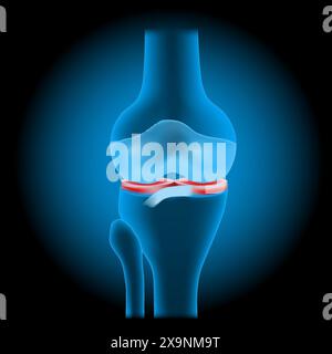 Knee meniscus injuries. Knee joint anatomy. Realistic transparent blue joint with glowing effect on dark background. vector illustration like X-ray im Stock Vector