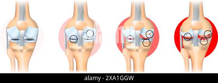 Stages of knee joint osteoarthritis. From Minimum disruption to lost a cartilage and joint-space reduction. Anatomy of knee joint. Vector illustration Stock Vector